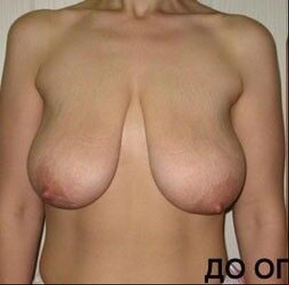 Breasts Normal Cupsize